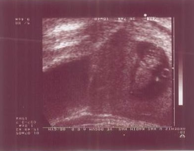 Ender Patrick Parry 8 weeks after conception